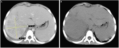 A case report of IgG4-related hepatic inflammatory pseudotumor in a 3-year old boy